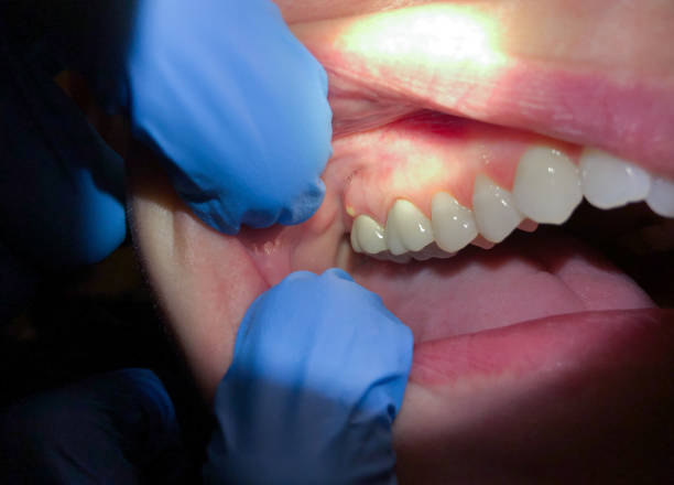 Best Emergency Dental Surgery in Wona Lake, IN